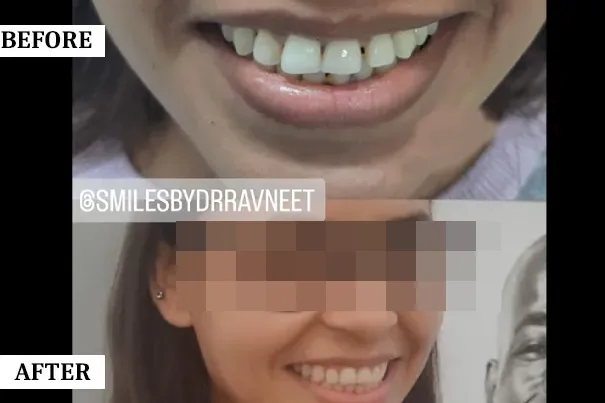 Smile Transformation 1