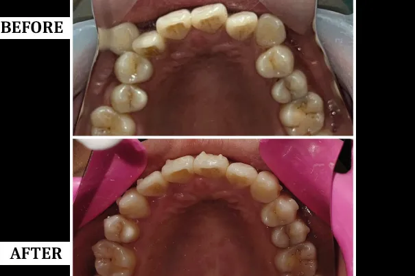 Smile Transformation 2