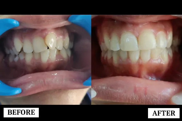 Smile Transformation 5